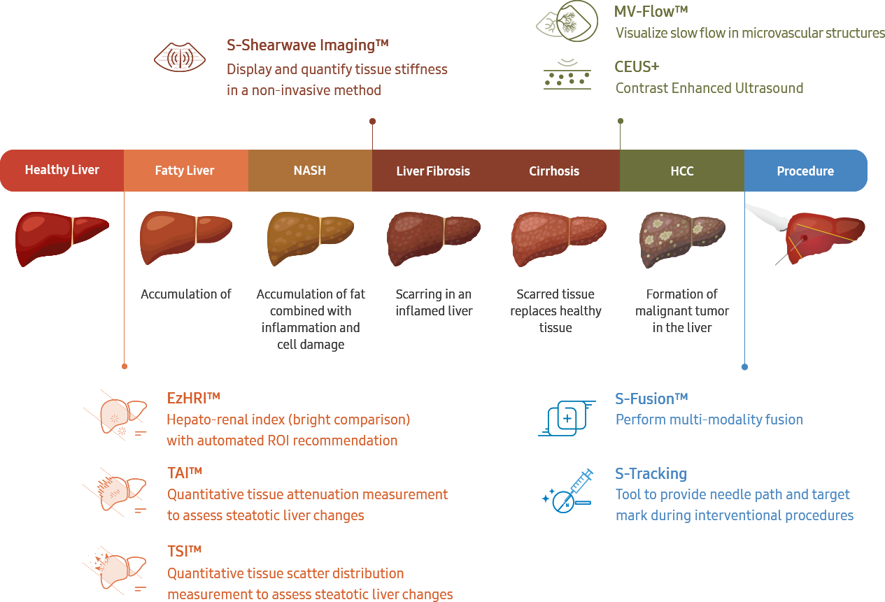 Samsung Liver Analysis Solution — Diagnostic pathway from fatty liver through fibrosis to HCC