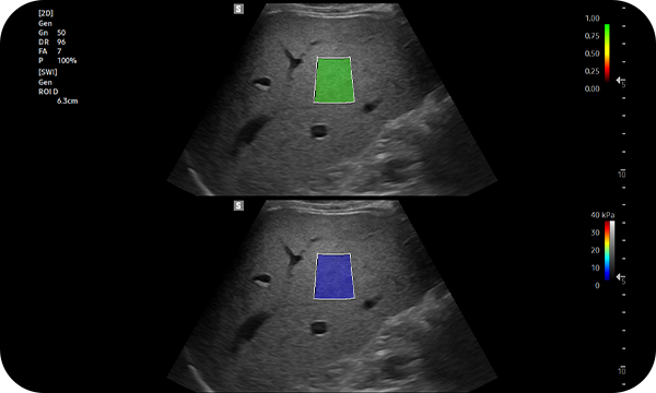S-Shearwave Imaging™ — Color-coded elastogram