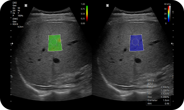 S-Shearwave Imaging™ — Elastography measurement of liver