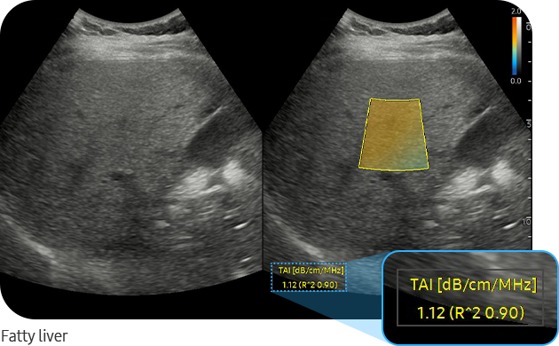 TAI™ — Fatty liver