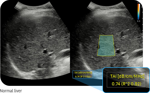 TAI™ — Normal liver
