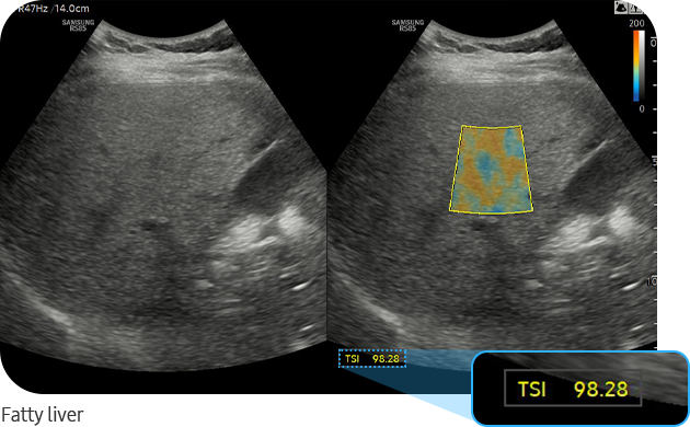 TSI™ — Fatty liver