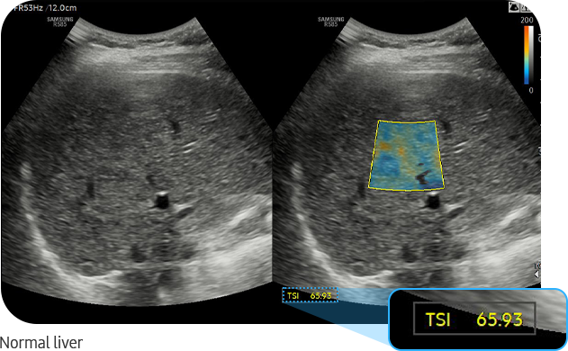 TSI™ — Normal liver